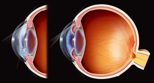 glaucoma