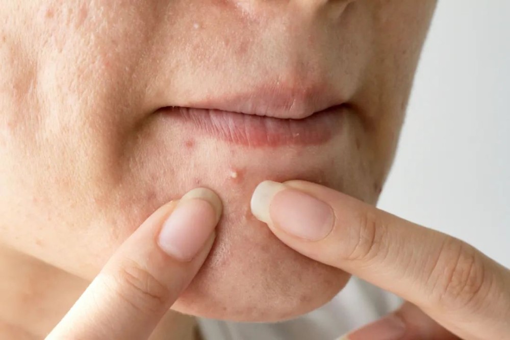 Long acne