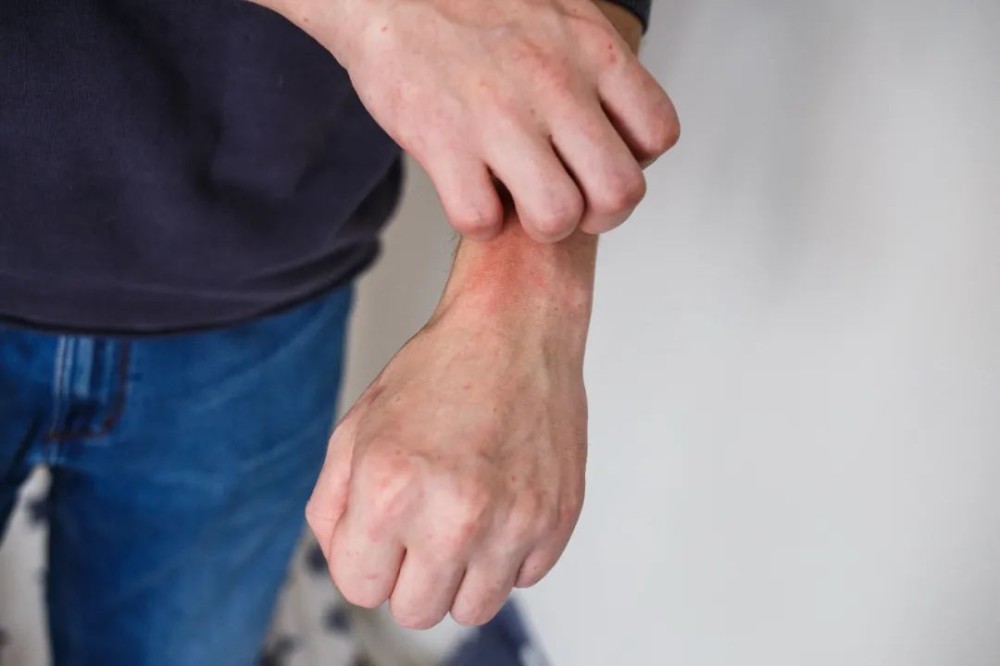 Skin itching