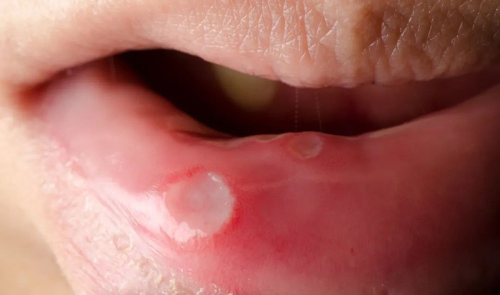 Excessive heat and oral ulcers
