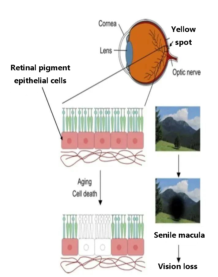 Age-related macular degeneration