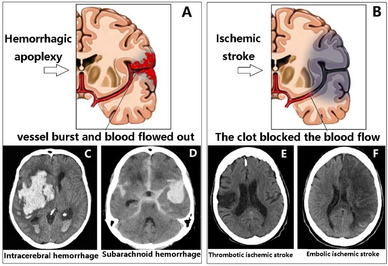 Cerebral hemorrhage