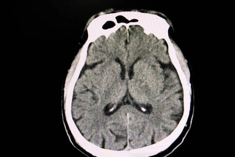 Citicoline can improve brain circulation