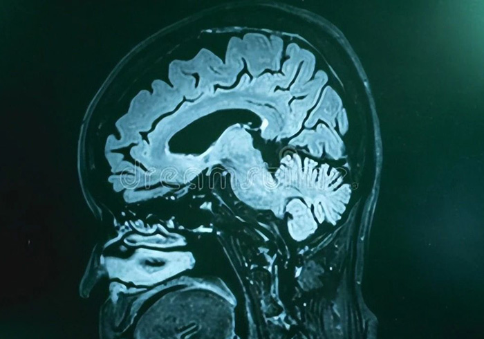 Citicoline can improve brain circulation