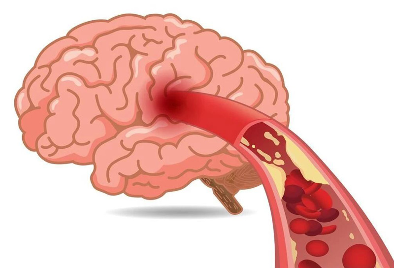 Citicoline can improve brain circulation